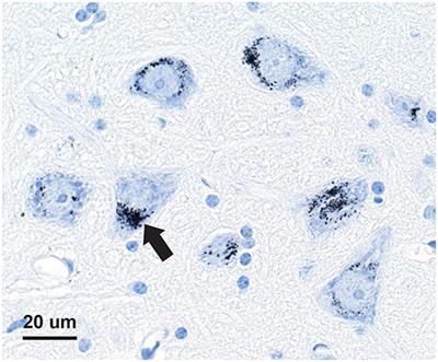 Elemental Analysis of Aging Human Pituitary Glands Implicates Mercury as a Contributor to the Somatopause